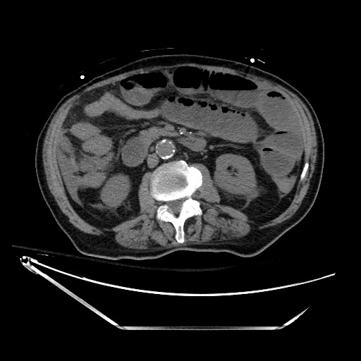 File:Closed loop obstruction due to adhesive band, resulting in small bowel ischemia and resection (Radiopaedia 83835-99023 Axial non-contrast 71).jpg