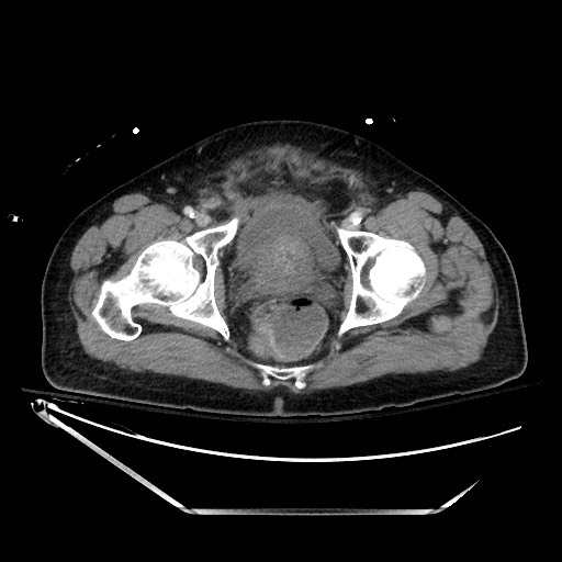 File:Closed loop obstruction due to adhesive band, resulting in small bowel ischemia and resection (Radiopaedia 83835-99023 D 145).jpg
