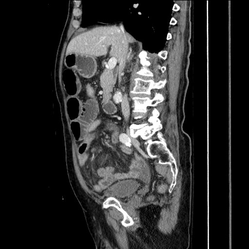 File:Closed loop obstruction due to adhesive band, resulting in small bowel ischemia and resection (Radiopaedia 83835-99023 F 84).jpg