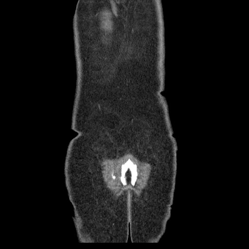 Closed loop small bowel obstruction (Radiopaedia 65403-74451 B 101).jpg