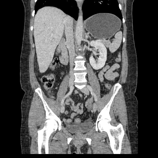 Closed loop small bowel obstruction (Radiopaedia 65403-74451 B 61).jpg