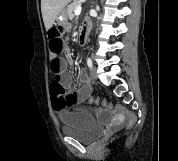 Closed loop small bowel obstruction (Radiopaedia 71211-81508 C 87).jpg