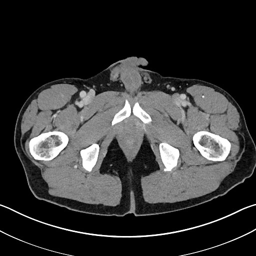 Closed loop small bowel obstruction - internal hernia (Radiopaedia 57806-64778 B 134).jpg