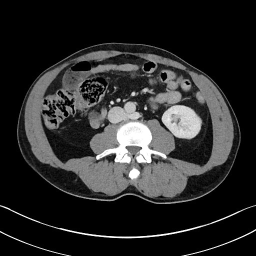 Closed loop small bowel obstruction - internal hernia (Radiopaedia 57806-64778 B 65).jpg