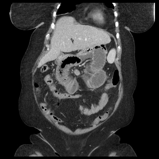 Closed loop small bowel obstruction - internal hernia (Radiopaedia 65402-74450 B 31).jpg