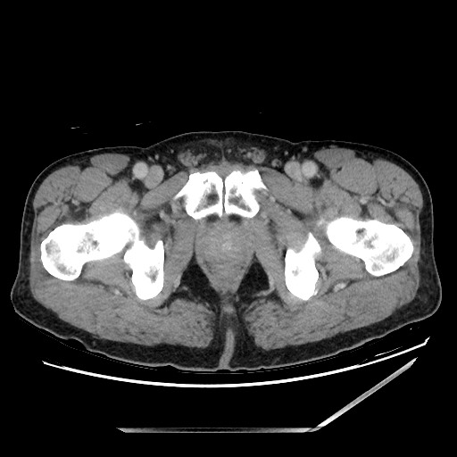 Closed loop small bowel obstruction - omental adhesion causing "internal hernia" (Radiopaedia 85129-100682 A 173).jpg