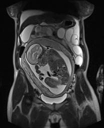 File:Closed loop small bowel obstruction in pregnancy (MRI) (Radiopaedia 87637-104031 Coronal T2 24).jpg