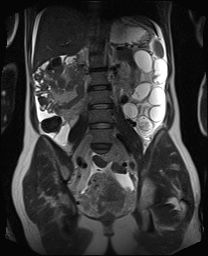 File:Closed loop small bowel obstruction in pregnancy (MRI) (Radiopaedia 87637-104031 Coronal T2 36).jpg