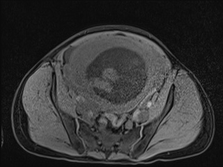 Closed loop small bowel obstruction in pregnancy (MRI) (Radiopaedia 87637-104031 F 42).jpg