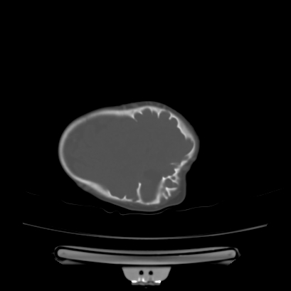 Cloverleaf skull (Radiopaedia 91901-109710 Axial bone window 127).jpg