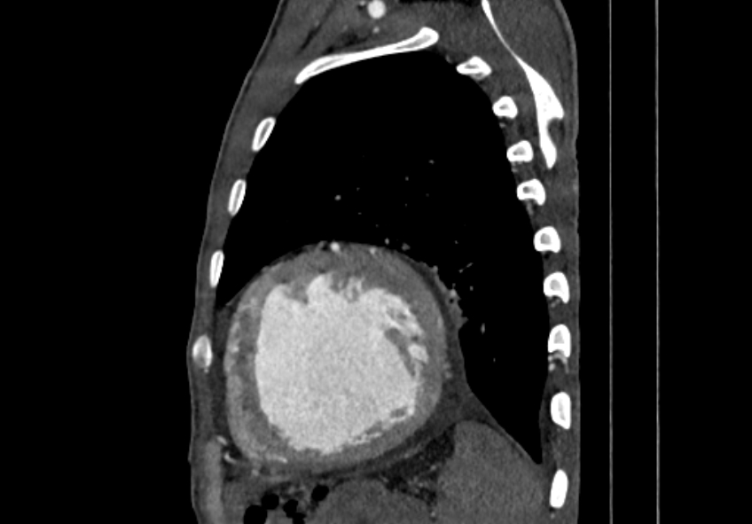 Coarctation of aorta with aortic valve stenosis (Radiopaedia 70463-80574 B 178).jpg