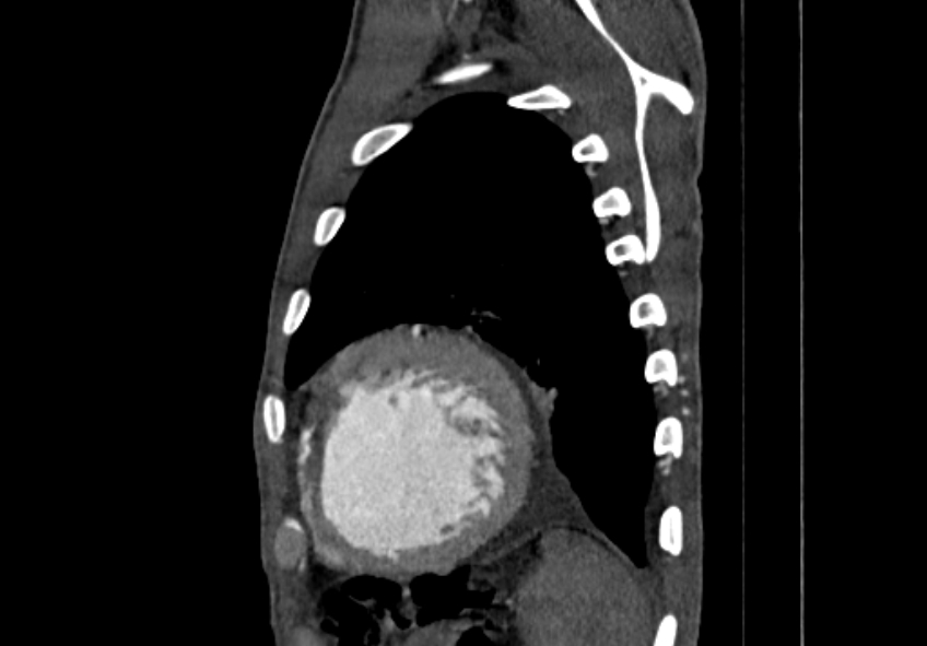 Coarctation of aorta with aortic valve stenosis (Radiopaedia 70463-80574 B 198).jpg