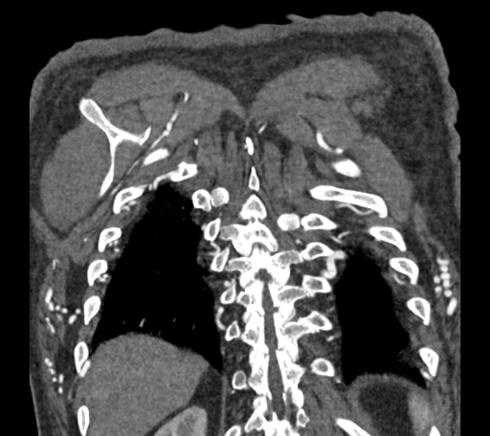 Coarctation of the aorta (Radiopaedia 53752-59822 B 73).jpg
