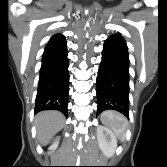 File:Coarctation of the aorta (Radiopaedia 67609-77010 B 13).jpg