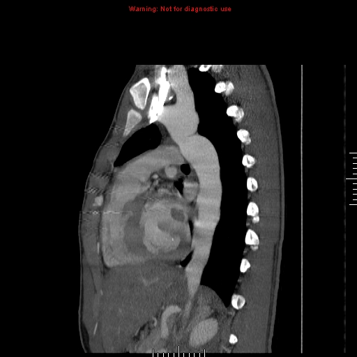 File:Coarctation of the aorta (Radiopaedia 9434-10118 B 37).jpg