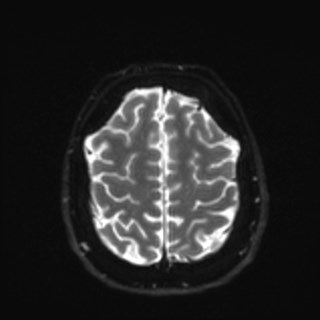 Cochlear incomplete partition type III associated with hypothalamic hamartoma (Radiopaedia 88756-105498 Axial DWI 34).jpg