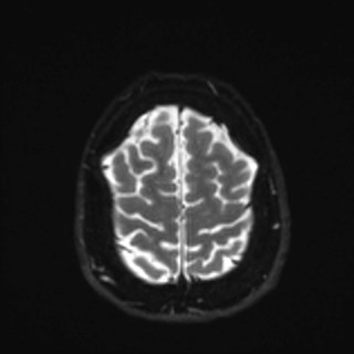 Cochlear incomplete partition type III associated with hypothalamic hamartoma (Radiopaedia 88756-105498 Axial DWI 36).jpg