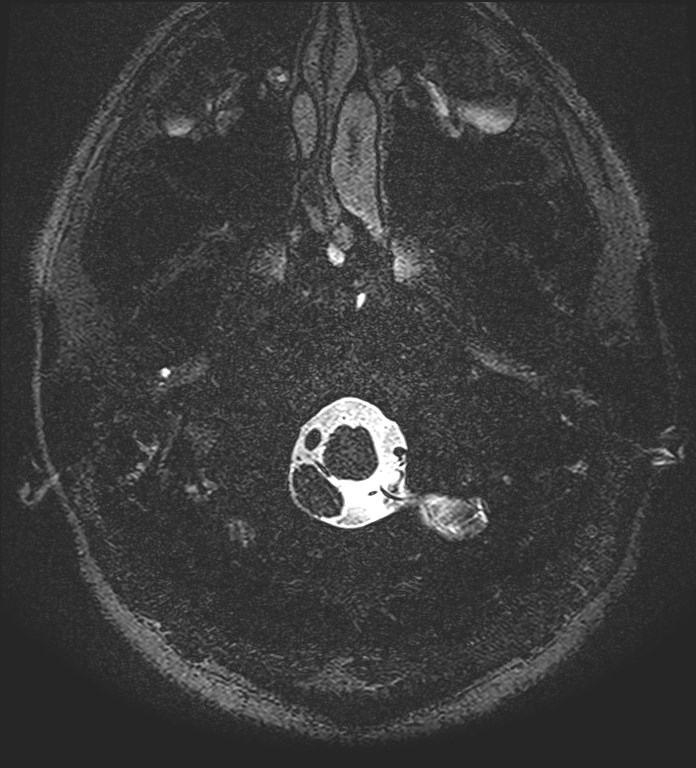 Cochlear incomplete partition type III associated with hypothalamic hamartoma (Radiopaedia 88756-105498 Axial T2 6).jpg
