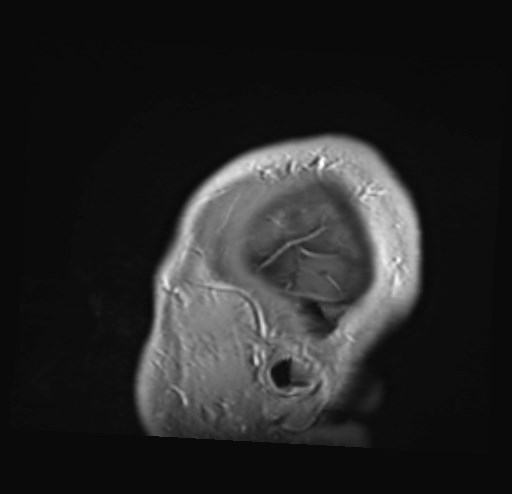 Cochlear incomplete partition type III associated with hypothalamic hamartoma (Radiopaedia 88756-105498 Sagittal T1 C+ 4).jpg