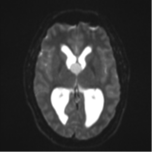 File:Colloid cyst (Radiopaedia 53164-59125 Axial DWI 14).png