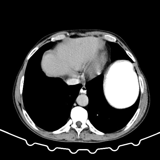 File:Colocolic intussusception due to large lipoma (Radiopaedia 68773-78482 A 7).jpg
