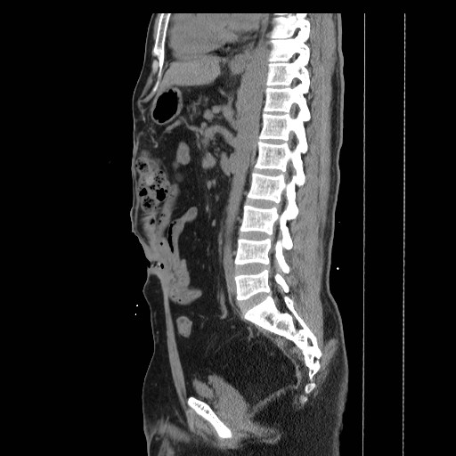 File:Colocutaneous fistula in Crohn's disease (Radiopaedia 29586-30093 C 28).jpg