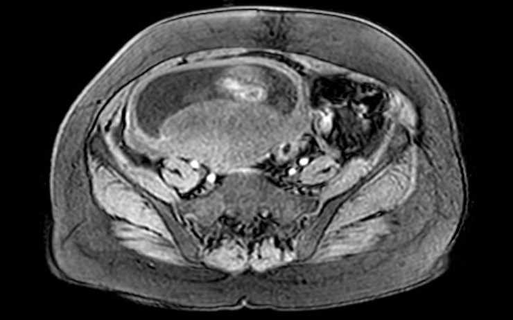 File:Colon adenocarcinoma with Krukenberg tumors, advanced pregnancy (Radiopaedia 67279-76645 A 27).jpg