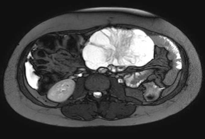 Colon adenocarcinoma with Krukenberg tumors, advanced pregnancy (Radiopaedia 67279-76645 Axial T2 SPAIR 43).jpg