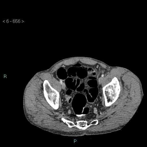 File:Colonic cancer (ultrasound and TC imaging) (Radiopaedia 50346-55713 A 123).jpg