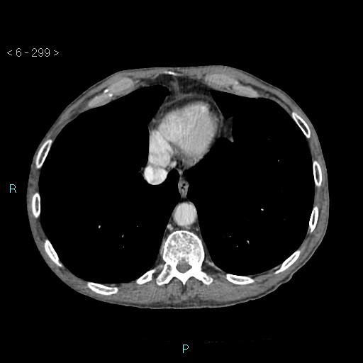 File:Colonic cancer (ultrasound and TC imaging) (Radiopaedia 50346-55713 B 299).jpg