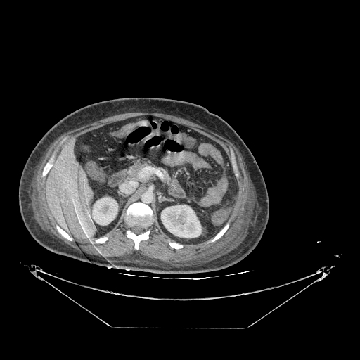 Colonic infarction after colostomy creation (Radiopaedia 81157-94797 A 41).jpg