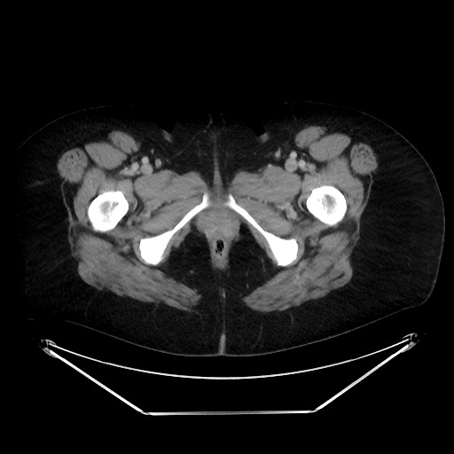 File:Colonic intussusception due to adenocarcinoma (Radiopaedia 86828-102987 A 156).jpg