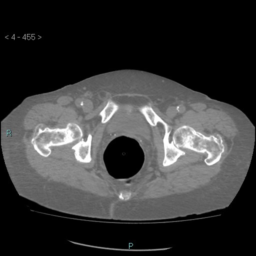 File:Colonic lipomas (Radiopaedia 49137-54244 Axial bone window 203).jpg