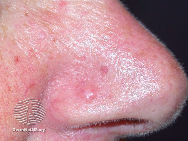 File:Fibrous papule of the nose (DermNet NZ lesions-fibrous-papule1).jpg