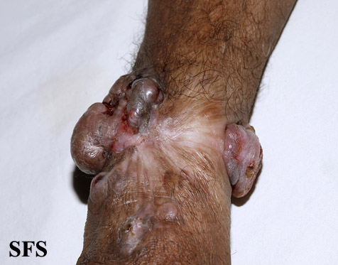 File:Melanoma (Dermatology Atlas 55).jpg