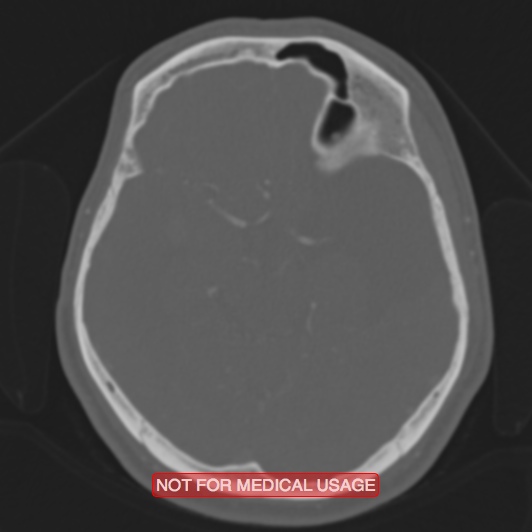 Nasopharyngeal carcinoma recurrence - skull base destruction (Radiopaedia 29107-29490 Axial bone window 62).jpg