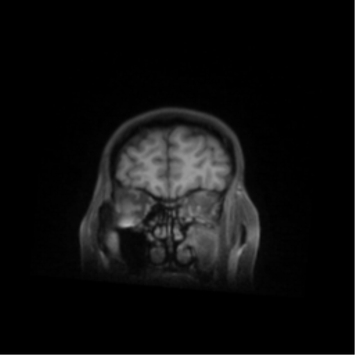 File:Nasopharyngeal carcinoma with cerebral abscess (Radiopaedia 43018-46274 Coronal T1 fat sat 12).png