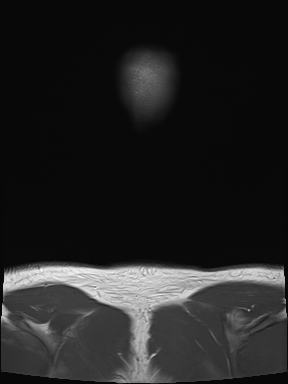 File:Nasopharyngeal carcinoma with perineural spread (Radiopaedia 55030-61380 Coronal T1 29).jpg