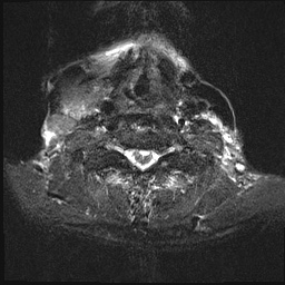 File:Nasopharyngeal carcinoma with skull base invasion (Radiopaedia 59258-66600 Axial T2 fat sat 12).jpg