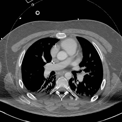 Neck CT angiogram (intraosseous vascular access) (Radiopaedia 55481-61945 B 16).jpg