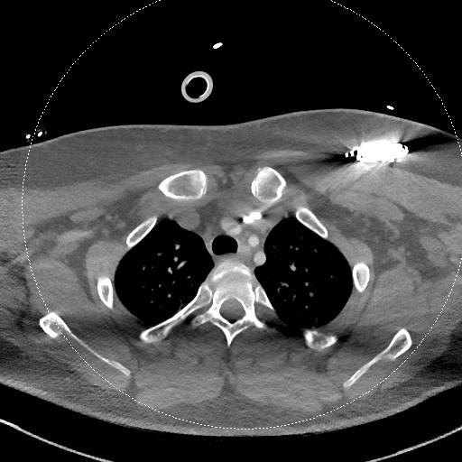 Neck CT angiogram (intraosseous vascular access) (Radiopaedia 55481-61945 B 76).jpg
