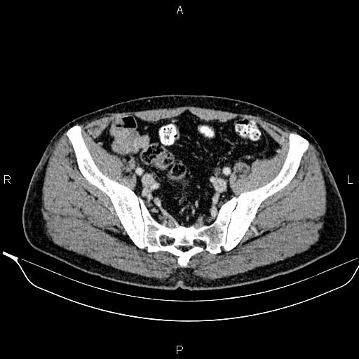 Necrotizing pancreatitis (Radiopaedia 87796-104249 A 46).jpg