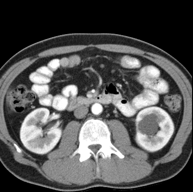 File:Necrotizing pancreatitis with acute necrotic collection (Radiopaedia 14470-14417 B 23).jpg