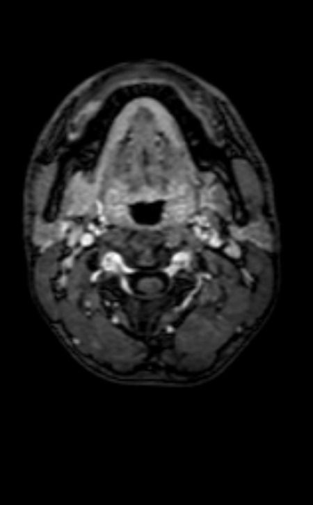 Neuro-Behçet disease (Radiopaedia 90112-107294 Axial T1 C+ 238).jpg