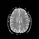 File:Neuro-Behcet's disease (Radiopaedia 21557-21505 Axial ADC 15).jpg