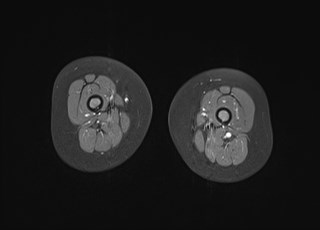 File:Neuroblastoma with bone metastases (Radiopaedia 67080-76414 Axial T1 C+ fat sat 24).jpg
