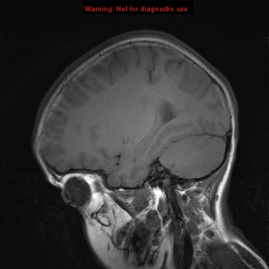 File:Neurofibromatosis type 1 with optic nerve glioma (Radiopaedia 16288-15965 Sagittal T1 17).jpg