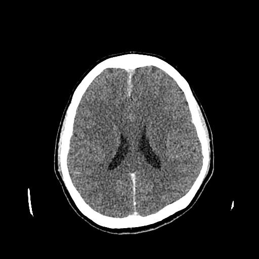 File:Neurofibromatosis type 2 (Radiopaedia 25389-25637 Axial C+ 59).jpg