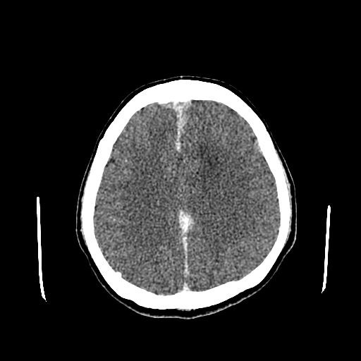 File:Neurofibromatosis type 2 (Radiopaedia 25389-25637 Axial C+ 67).jpg