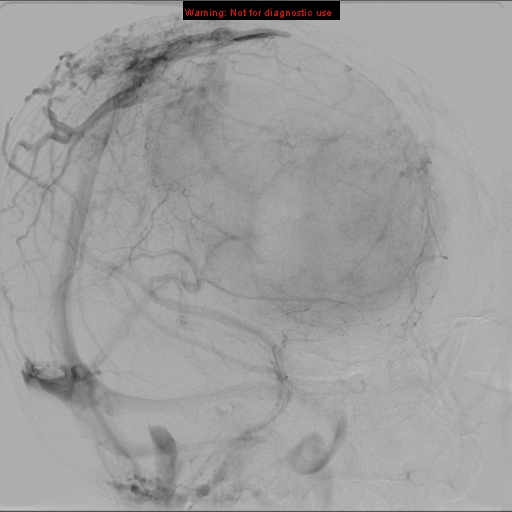 File:Neurofibromatosis type 2 (Radiopaedia 8953-9733 A 7).jpg